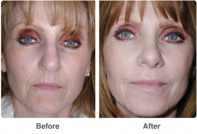 before-after-chemical-peel-1a