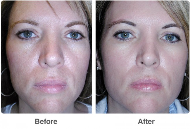 before-after-chemical-peel-2