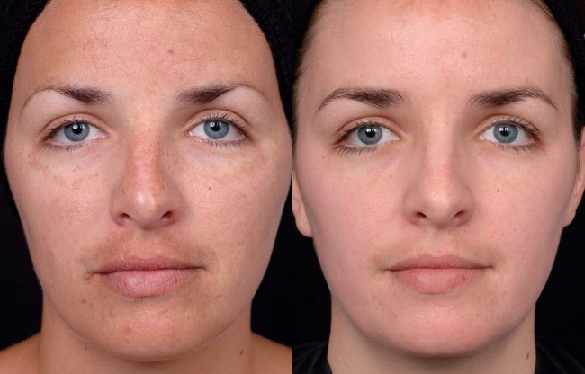 chemical-peel-2