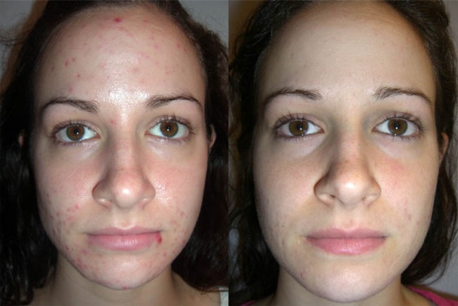 orlando-med-spa-before-after-facial-front