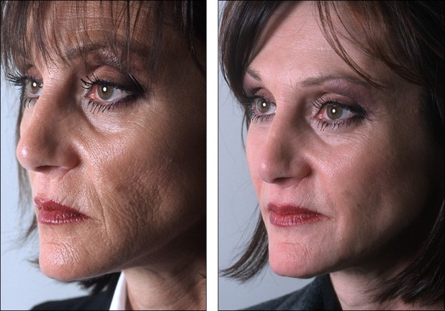 skin_peel_5257614545b
