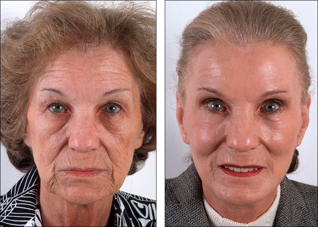 skin_peel_5742563660b